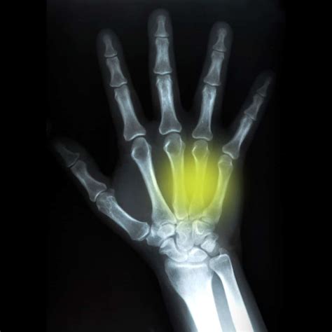 metal hand boxer|boxer's fracture on arm.